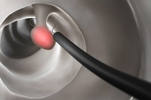 בדיקה גנטית של גידולי המעי הגס-תמונה