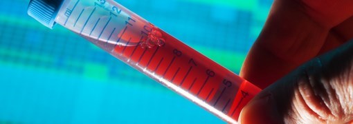 בדיקת Cardiolipin IgM - תמונה