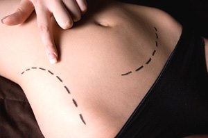 ניתוח בריאטרי: הסרת עודפי עור-תמונה