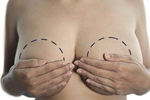 אסימטריה בשדיים: שאיפה לשוויון-תמונה