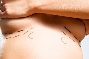 הקטנת שדיים בחתכים מינימאליים-תמונה