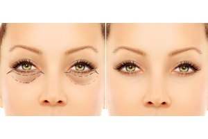ניתוח הרמת עפעפיים חדשני וללא צלקת-תמונה
