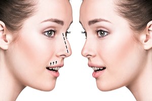 נעים להכיר: ניתוח אף, ללא ניתוח!-תמונה