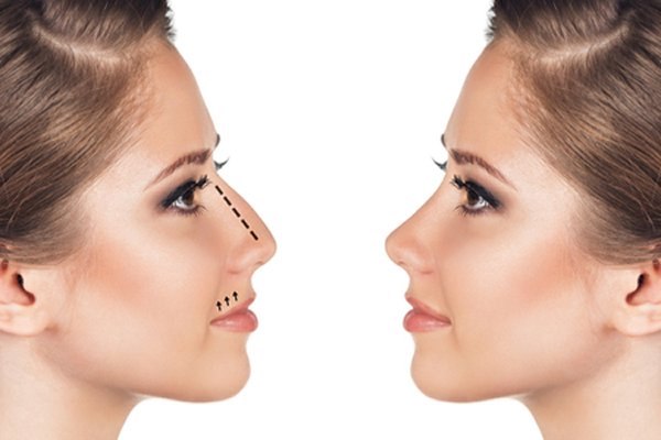 ניתוח אף: הבריאות קודמת ליופי-תמונה