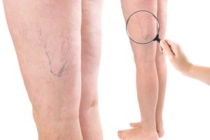 בעיות ורידים? יש טיפולים חדשניים-תמונה