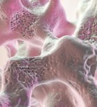 שברים אוסטאופורוטיים - תמונת אווירה