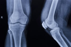 סוכרת: סיכון לשברים בעצמות-תמונה