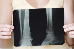 אוסטיאופורוזיס: מניעה, אבחון וטיפול-תמונה