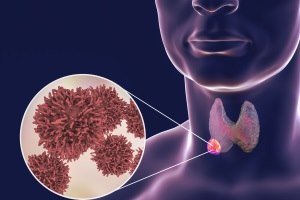 סרטן בלוטת התריס: תגלית ברמב"ם-תמונה