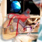 צינתור לב וירטואלי באמצעות CT-תמונה