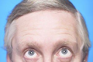 טיפול בהתקרחות - שעיר לנצח-תמונה