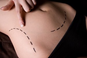 הסרת עודפי עור: מיתוסים ומציאות-תמונה