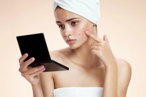 אקנה: נפרדים מפצעי הבגרות-תמונה