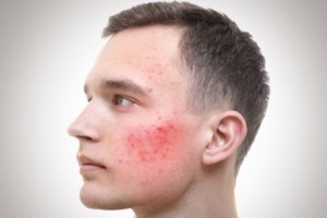 ג'ל חדש לטיפול באקנה-תמונה