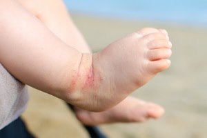 טקרולימוס - תמונת אווירה