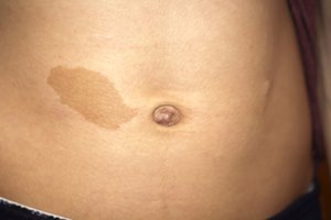 נוירופיברומטוזיס 1: אבחון וטיפול-תמונה