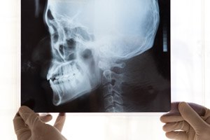 ניתוח לסת: העצם הודפסה והושתלה-תמונה