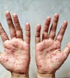 אבעבועות הקוף