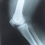 דלקת מפרקים שגרונית-תמונה