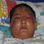 ילד נכווה בפניו מצריבת מדוזה