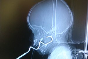 חלק ממיקסר חולץ מחך של פעוטה-תמונה