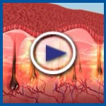 הסרת שיער בלייזר: SHR-תמונה