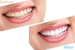 הלבנת שיניים בשעה אחת-תמונה