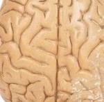 אלצהיימר, דיוקן אישי-תמונה