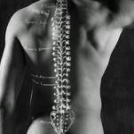 עקמת עמוד השדרה  Scoliosis