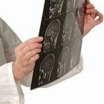 תסמונת מרפן-תמונה