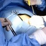 בקע (שבר) חוזר- RECURRENT HERNIA-תמונה