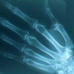 אוסטיאופורוזיס