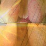 שמש, עור ופסוריאזיס גם-תמונה