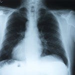 טיפול מהפכני בנפחת הריאות-תמונה