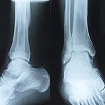 אור ועצמות - על אוסטיאופרוזיס-תמונה