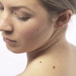 סרטן העור-תמונה