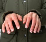 איבדתם תחושה בעור והוא מחליף צבעים? זהירות! כוויית קור-תמונה