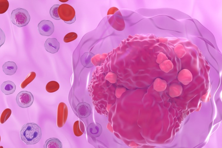 תאי דם בלתי תקינים בלוקמיה. הדמיה: שאטרסטוק