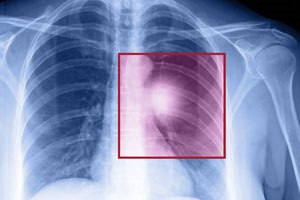 סרטן ריאה (אילוסטרציה)