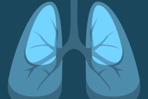 השתלת ריאות בחולה שהונשמה שנה-תמונה