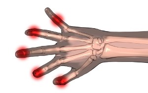 טיפול ביולוגי חדש לזאבת-תמונה