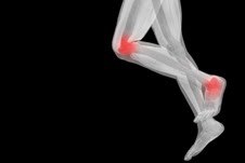 אוסטיאוארתריטיס ורפואה משלימה-תמונה