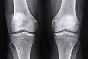 יום אבחון בכנסת: דלקות מפרקים-תמונה