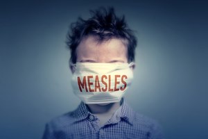 האם החצבת חוזרת?