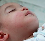 תסמונת קוואסקי או MIS-C? עדויות לדלקות בילדים שהחלימו מקורונה-תמונה