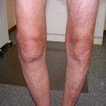 אוסטאוארתריטיס - כשהסחוסים נשחקים-תמונה