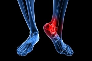 טיפול בתאי גזע לאיחוי שברים-תמונה