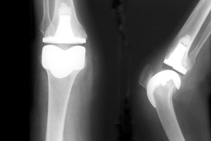 הקשר בין אקזמה לאוסטיאופורוזיס-תמונה