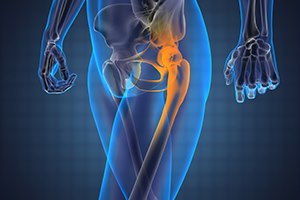 טריאתלון לאחר ניתוח במפרק הירך