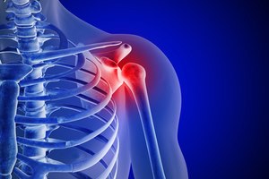 פגיעות כתף: כיצד לאבחן ולטפל?-תמונה